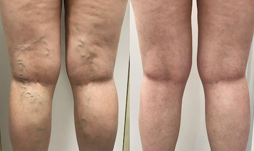 spider vein removal before after mississauga oakville